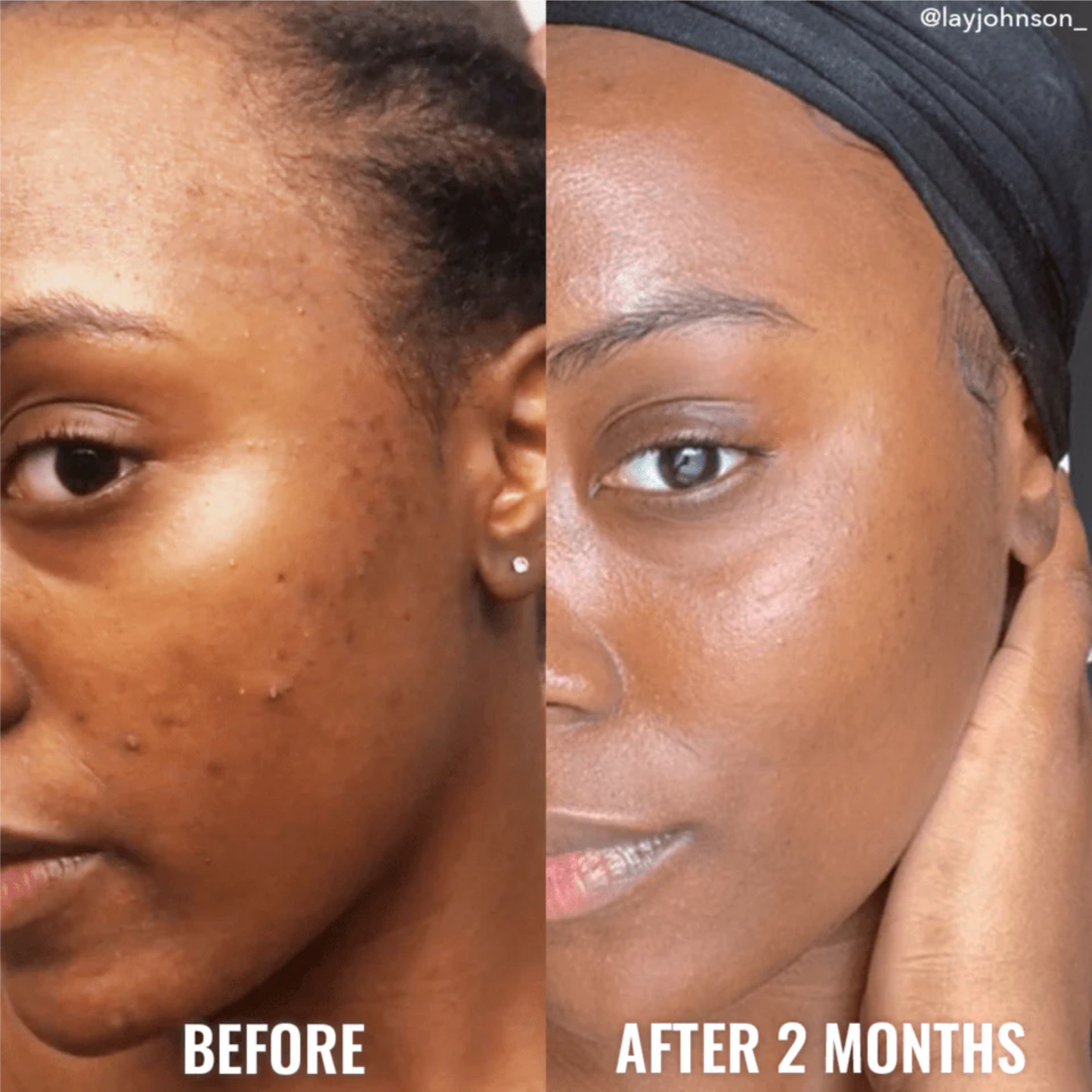 Set BLEMISH SCAR & DISCOLORATION SET GOOD MOLECULES